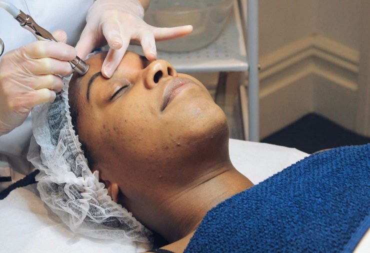 dermabrasion treatment